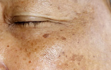 你不知道的祛斑消痘印小竅門，方便又省錢