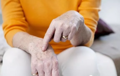 皮膚長(zhǎng)老年斑怎么去掉，學(xué)會(huì)4招“吃”掉老年斑