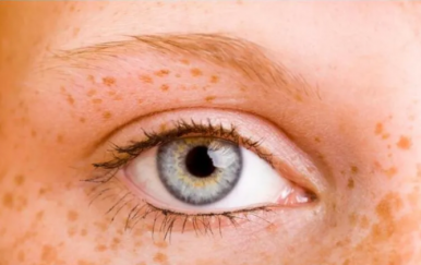 女人黃褐斑是怎么形成的？主要與這幾大因素有關(guān)