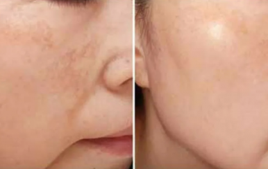 都說祛斑難，對不起，那是他因為你沒選對方法！